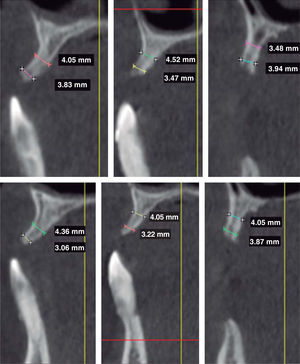 CBCT showing generalized horizontal bone resorption, although sufficient bone was vertically found in apicalcrown direction. From left to right, upper jaw: area of teeth 1.1, 1.2 and 1.4. From left to right in lower jaw: teeth number 2.1, 2.2 and 2.4.