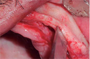 Bone chisel entering medullar portion, separating cortical ridge leading to greenstick fracture.