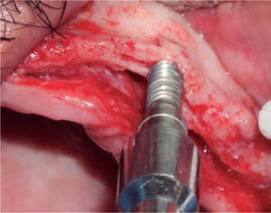 Bone widening using expanders, creating suitable access for a greater diameter burr.
