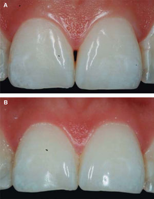 Interdental papilla comparison. A) Initial papilla before HA infiltrations. B) Papilla upon completion of 4 HA infiltrations.