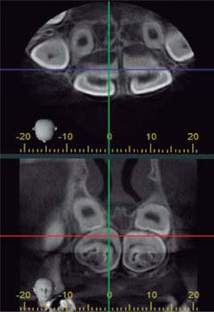 Radio-opaque image with radio-lucid halo in the upper anterior region.