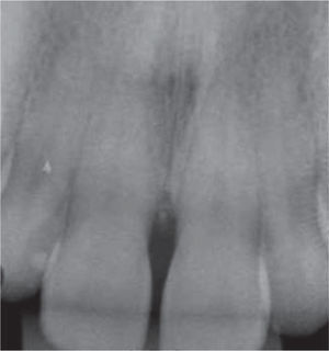 Radiografía periapical a nivel de piezas 1.1 y 2.1 Presencia de pérdida ósea crestal.