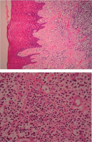 (HE 5x) Epitelio acantósico, hiperplasia pseudoepiteliomatosa, lámina propia, aparentemente canales vasculares e infiltrado inflamatorio (HE 10x) Canales vasculares tapizados de células endoteliales, infiltrado inflamatorio compuesto por linfocitos, células plasmáticas, histiocitos y ocasionales polimorfos nucleares.