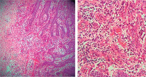 Hiperplasia pseudoepiteliomatosa y tejido de granulación, canales vasculares recubiertos por endotelio e ingurgitación de eritrocitos, infiltrado inflamatorio con predominio de neutrófilos e histiocitos.