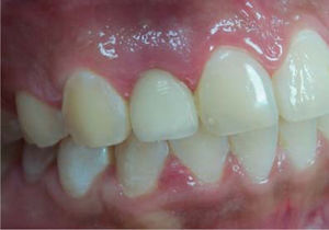 Vista inicial intraoral.