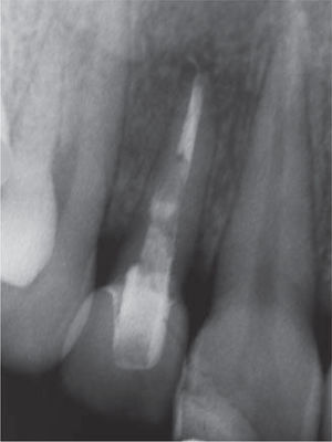 Radiografía inicial.