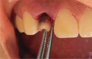 Exodoncia preservando alvéolo.