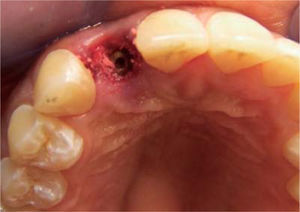 Posición 3D del implante.