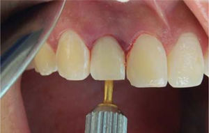 Restauración temporal.