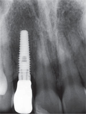 Radiografía periapical.