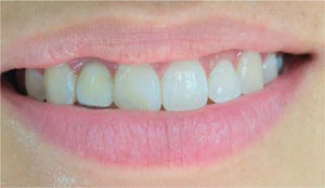 Mucosa periimplantar grisácea.