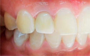 Restauración final atornillada.