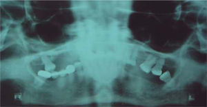 Imagen ortopantomográfica de la lesión con pérdida de continuidad del piso de seno maxilar derecho.