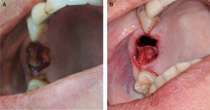 A) Lesión ósea al momento quirúrgico. B) Imagen posquirúrgica a la inserción de las membranas de colágeno, previo cierre parcial.