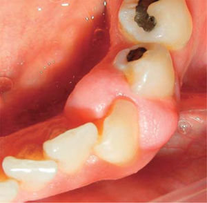 Occlusal view of the lesion.