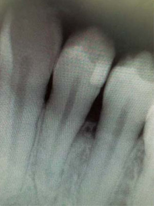 Periapical X-ray of the lesion area. Absence of interproximal contact between teeth 3.4 and 3.5.