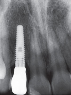 Periapical X-ray.