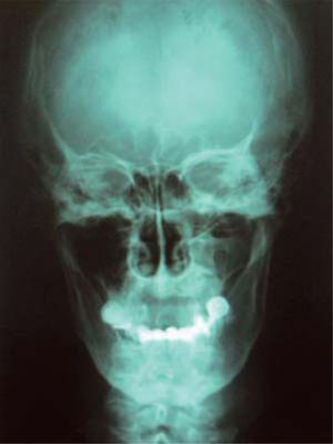 Anterior-posterior radiographic projection revealing extensive bone loss in the right jaw.
