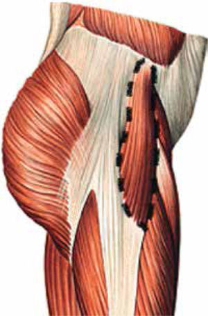 Fascia lata tensor muscle.12
