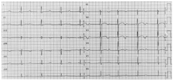 Thoracoscopic Denervation Of The Left Cardiac Sympathetic Nerve To ...