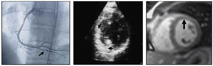 Myocardial Echocardiography With Intracoronary Injection of Contrast in ...
