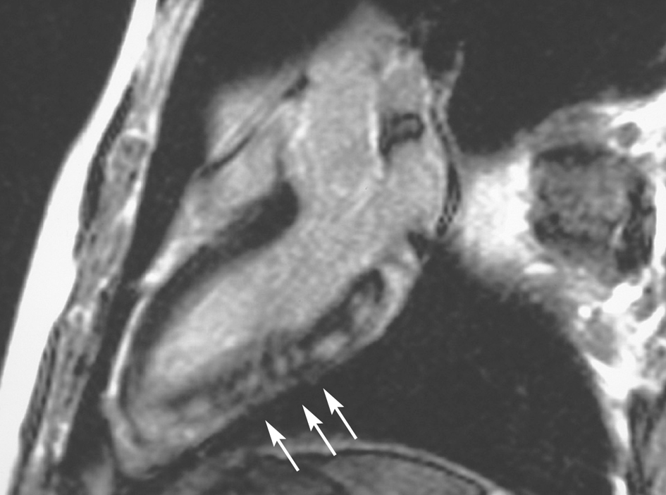 Diagnosis Of Acute Myocarditis By Contrast-Enhanced Cardiac Magnetic ...