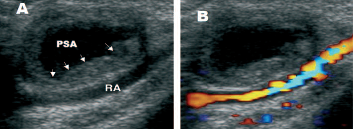 Unusual Complications of Cardiac Catheterization Via the Radial Artery ...