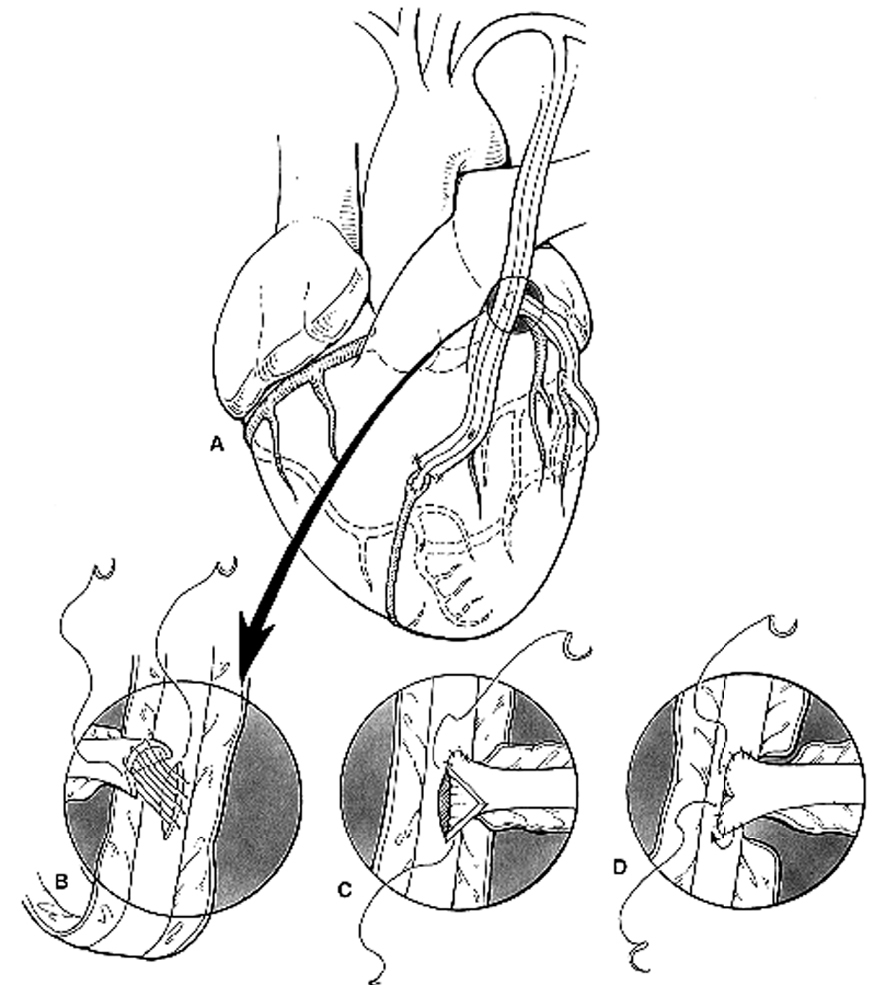 Off-Pump Coronary Artery Bypass Grafting and Other Minimally Invasive ...