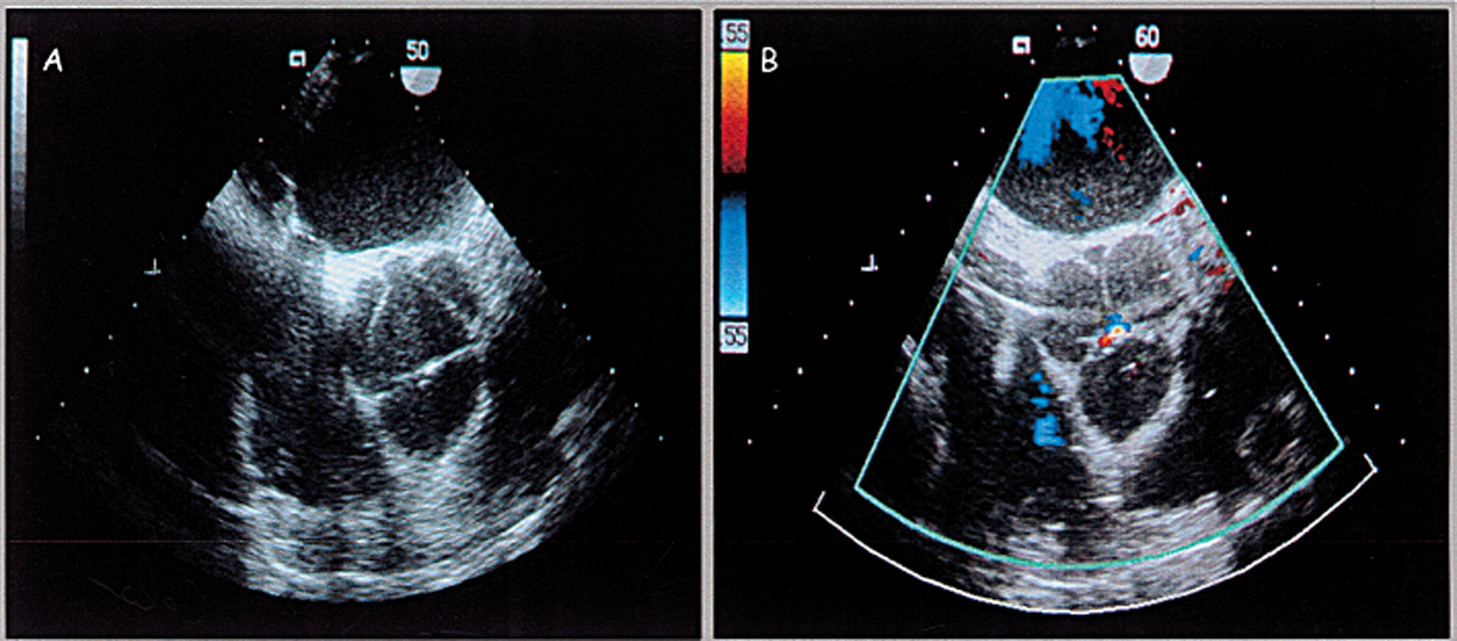 Aortic Insufficiency of Unusual Etiology Susceptible to Surgical Repair ...