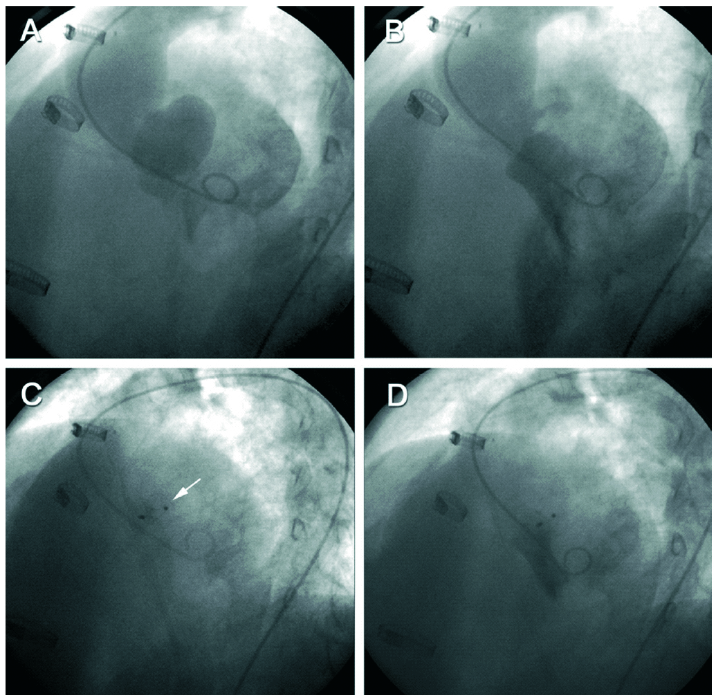 Percutaneous Closure of Pseudoaneurysm of the Mitral-Aortic ...