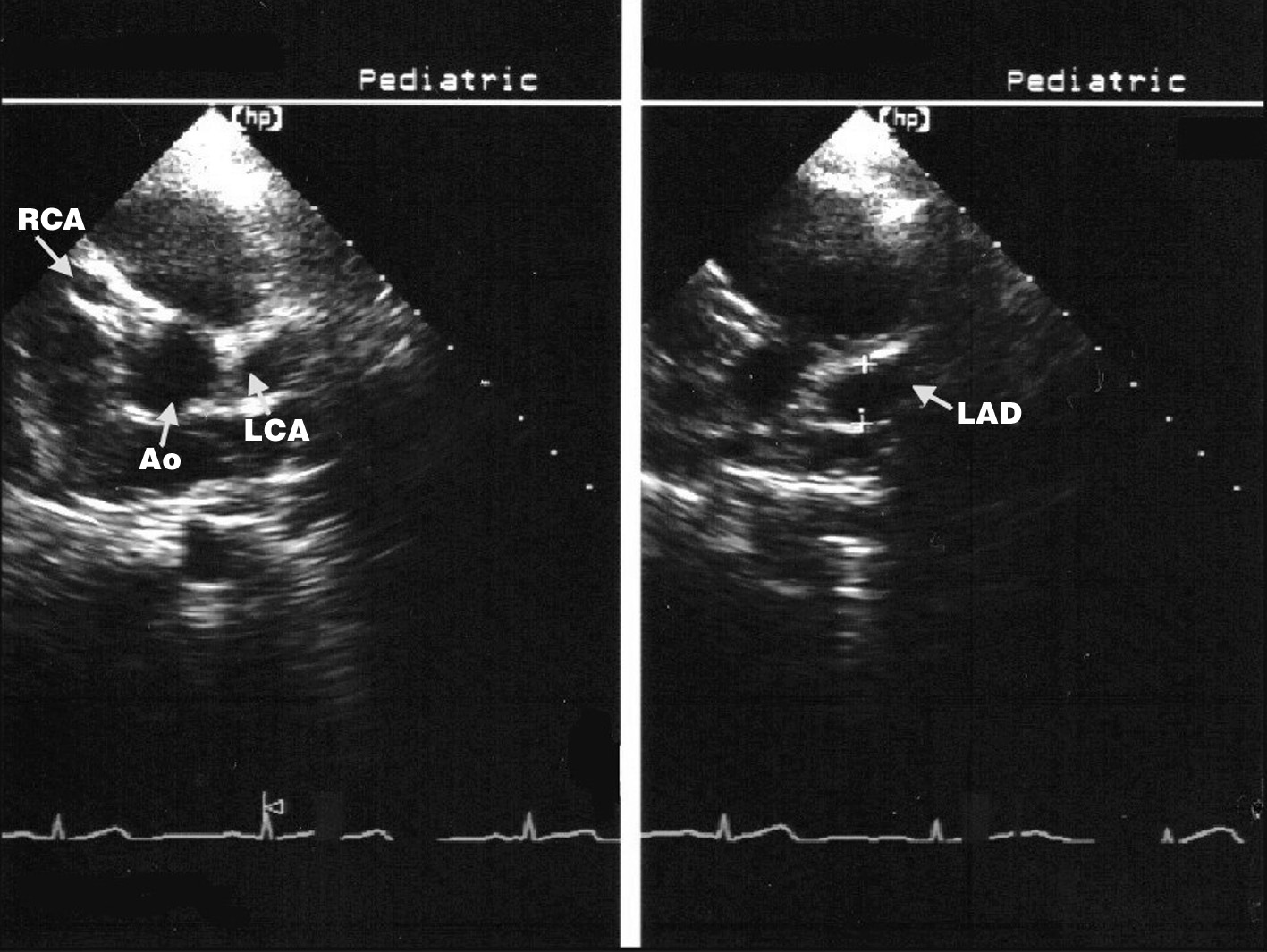 Kawasaki Disease Heart Disease During Childhood Revista Española de