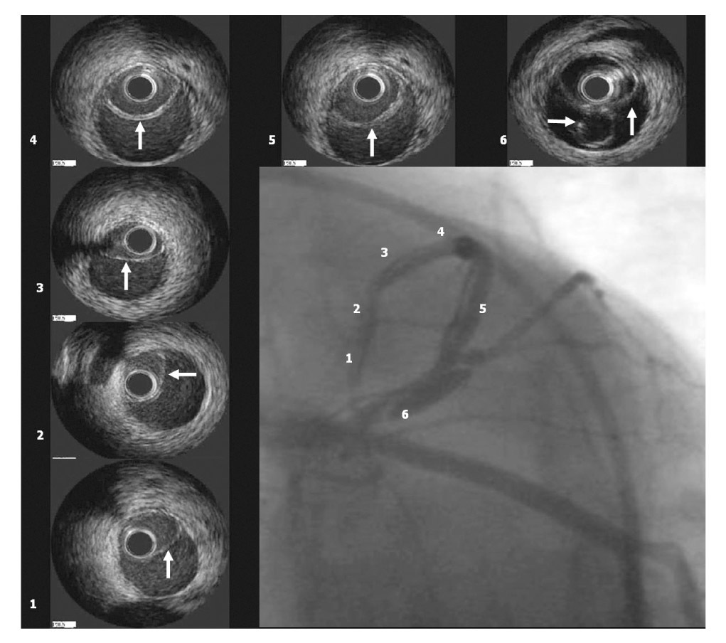 Intravascular Ultrasound Guided Percutaneous Treatment In A Case Of