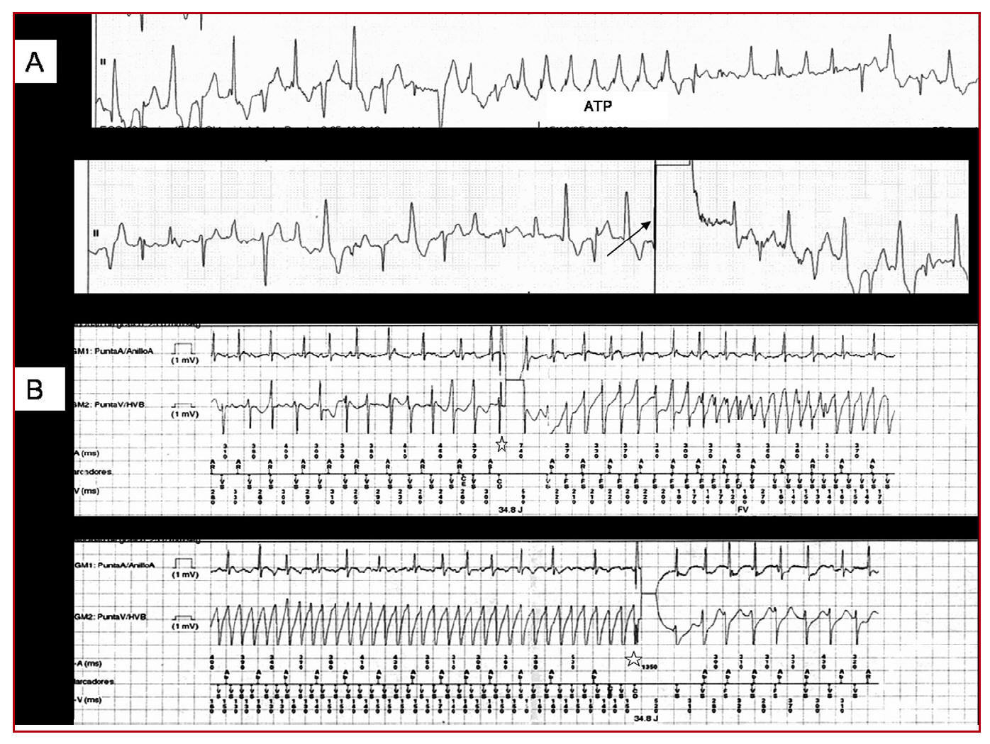 Arrhythmic Storm Induced by AICD Discharge in a Patient With ...