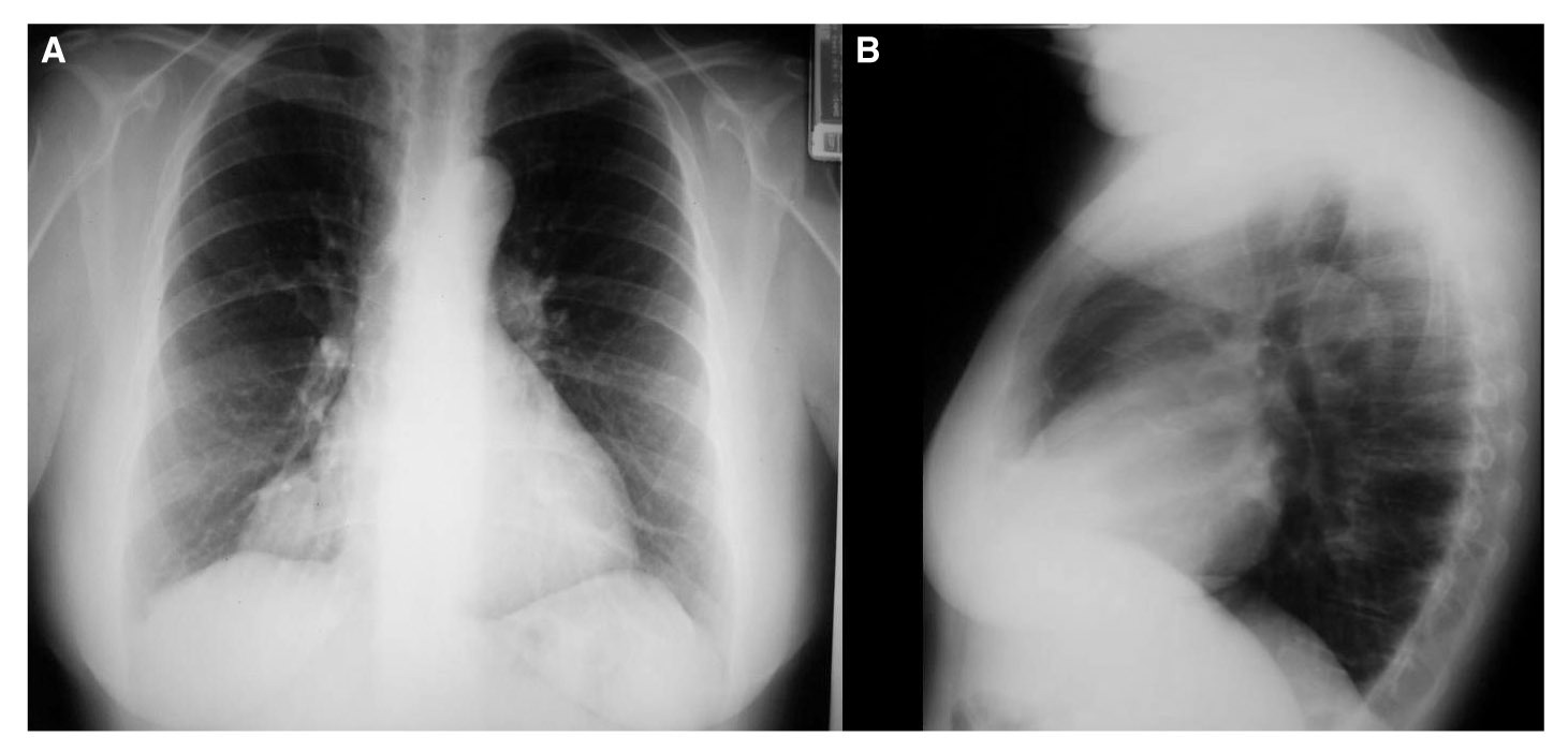 Pericardial Cyst: All¿s Well That Ends Well | Revista Española de ...