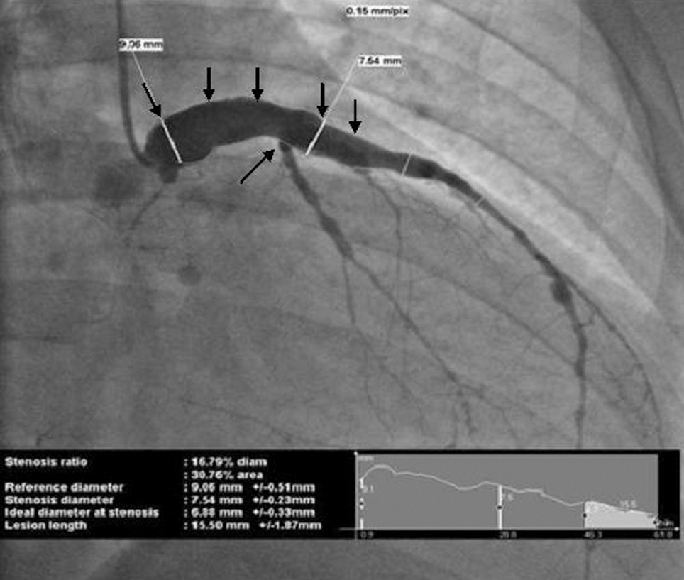 Kawasaki Disease With Coronary Artery Lesions in Adults | Revista ...