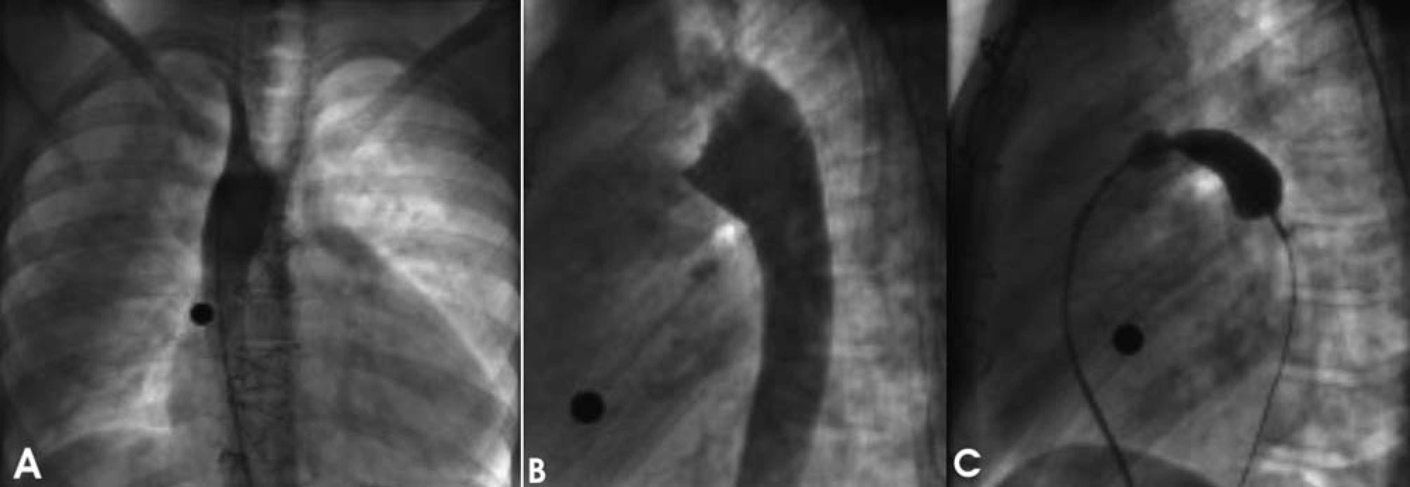 Krichenko Right Patent Ductus Arteriosus With an Ipsilateral Aortic Arch ...