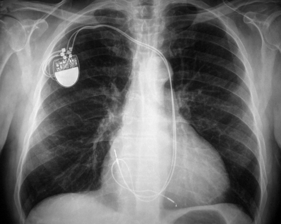 Pacemaker Implantation Via a Persistent Left Superior Vena Cava ...