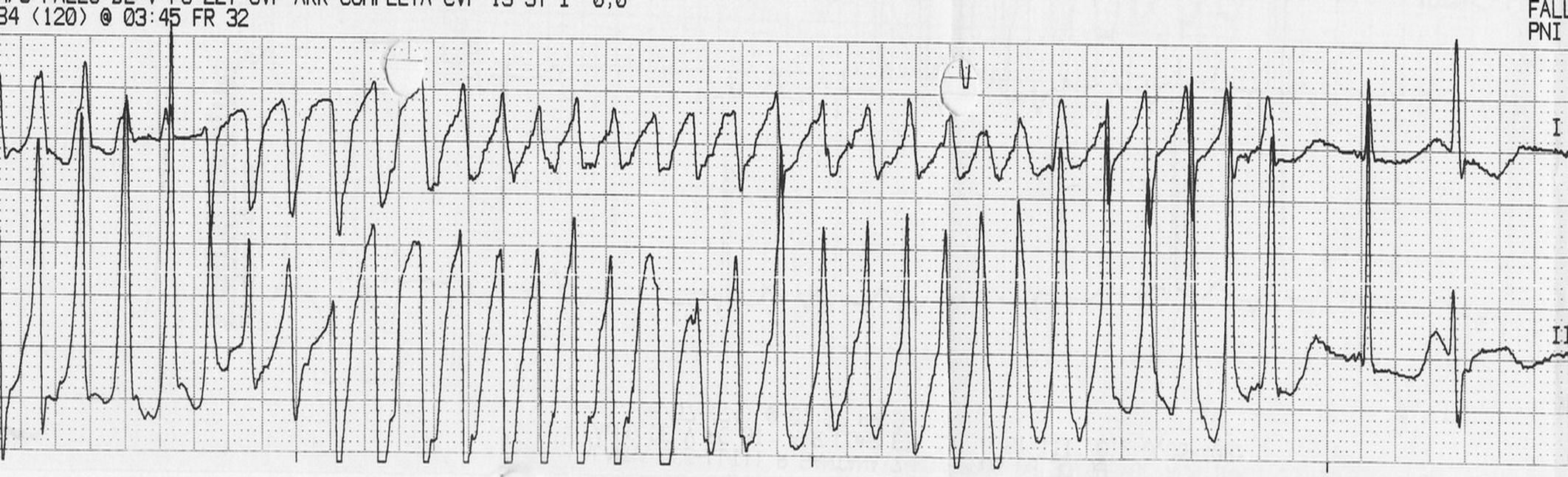 Malignant Ventricular Arrhythmias As The Initial Manifestation Of 