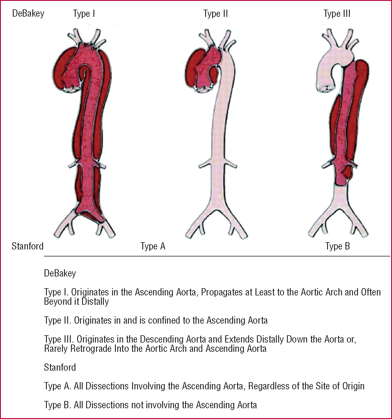 Management of Acute Aortic Syndromes | Revista Española de Cardiología