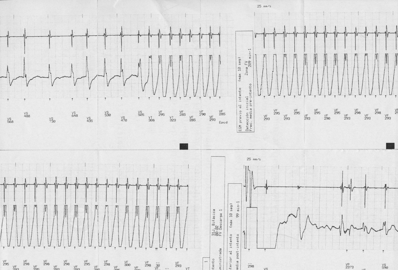 LongTerm FollowUp of Hypertrophic Cardiomyopathy Patients With
