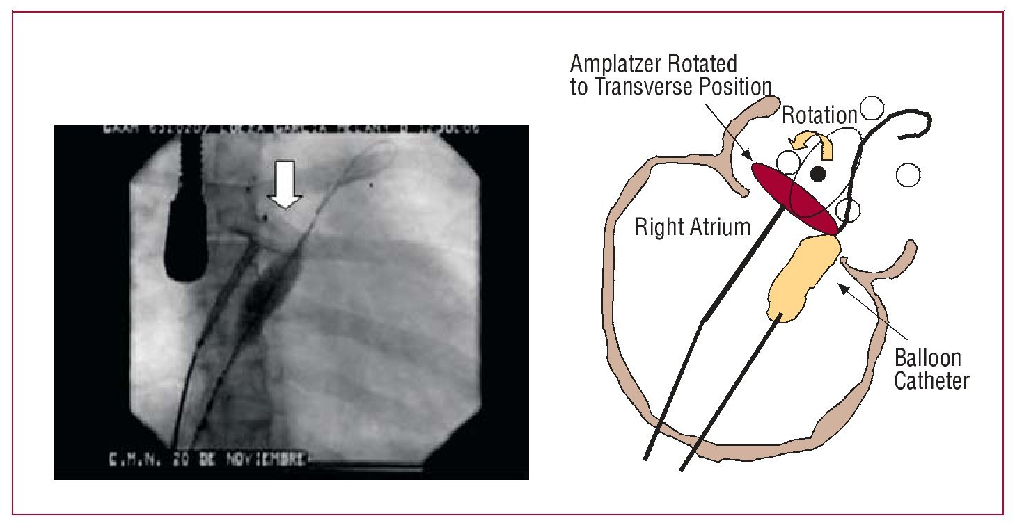 Position de perforation