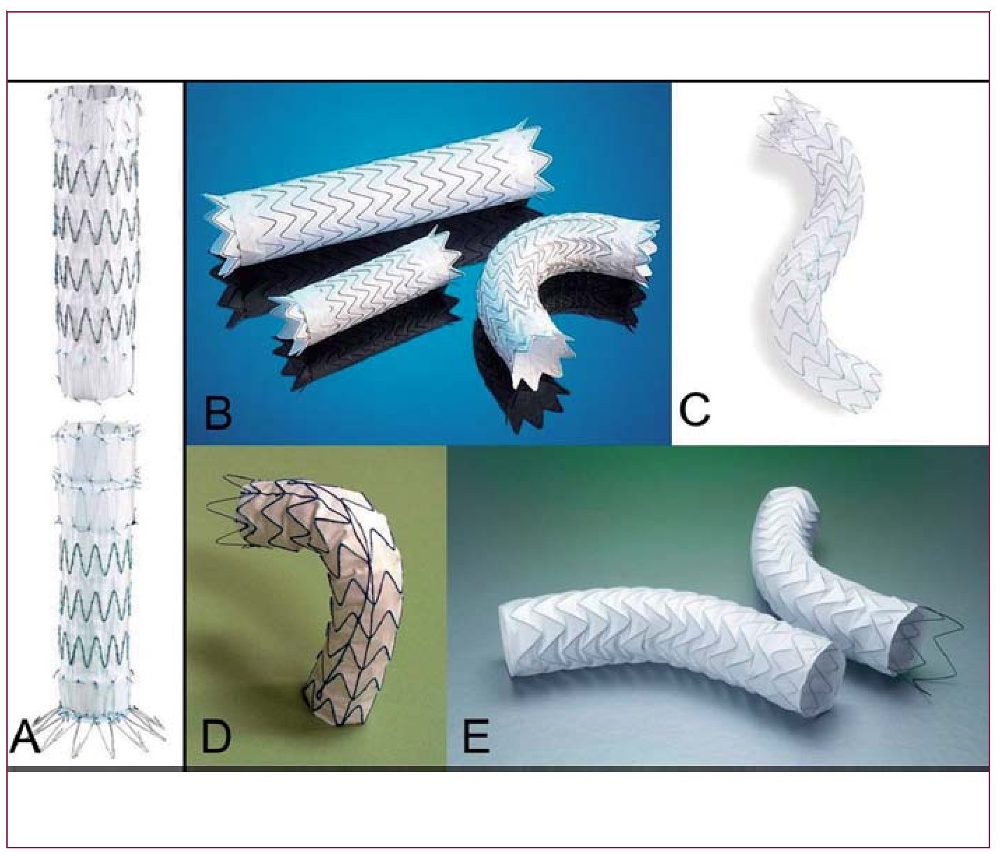 Stent-Graft Repair in Acute and Chronic Diseases of the Thoracic Aorta ...