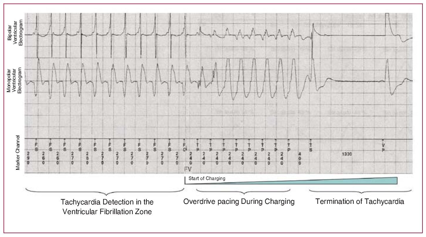 Reducing Cardioverter-Defibrillator Shock Administration by ...