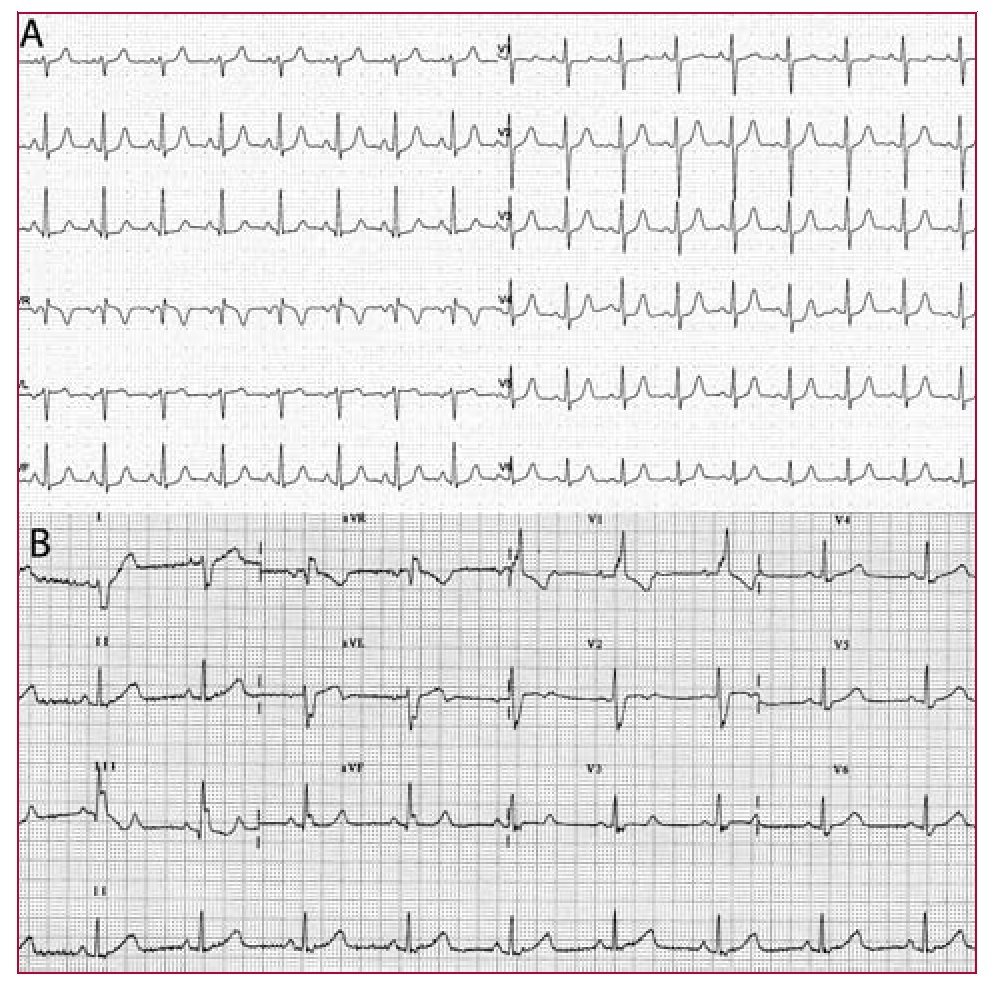 Infra-hisian Atrioventricular Block Secondary to Radiotherapy - Revista ...