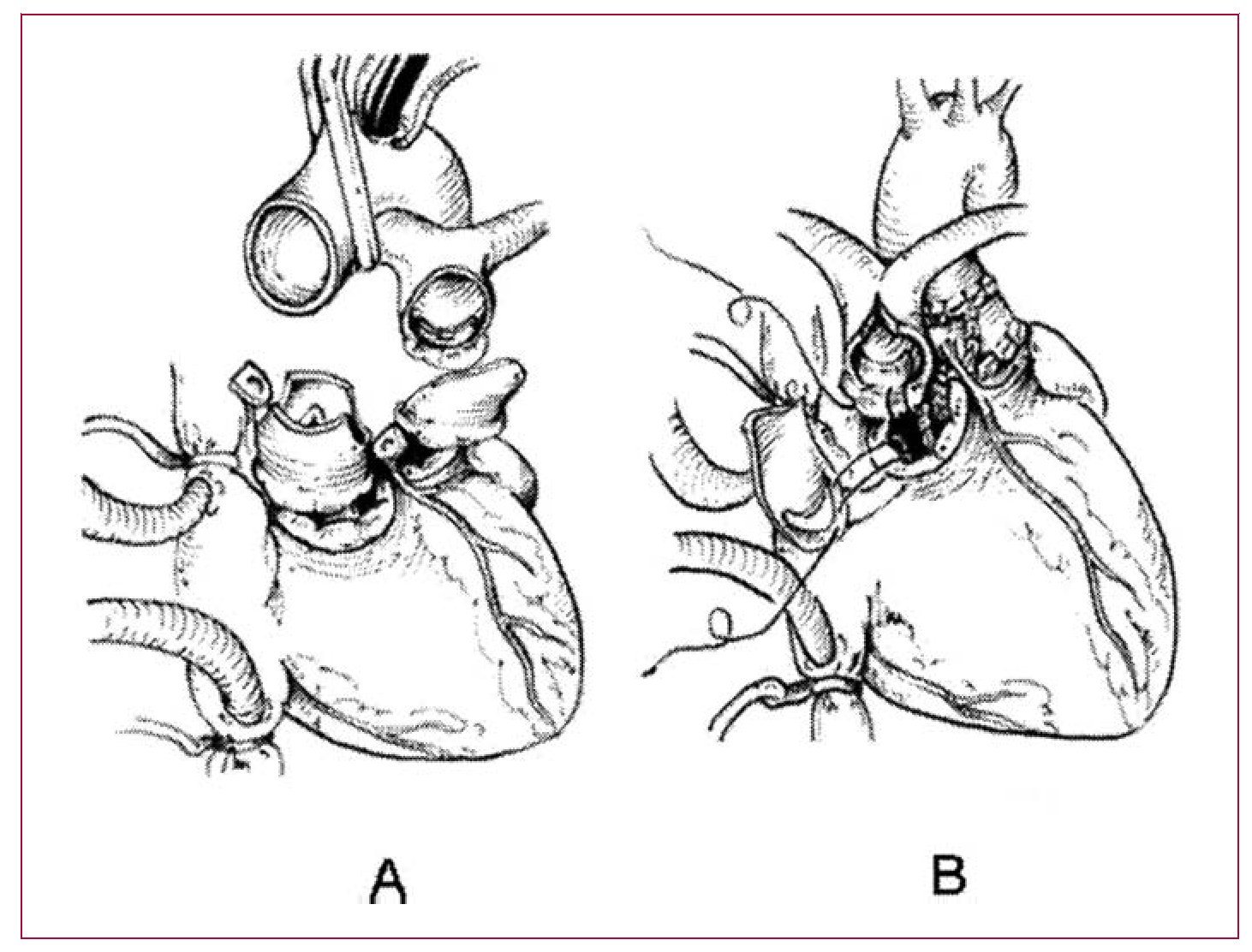 Nikaidoh Procedure for the Correction of Transposition of the Great ...