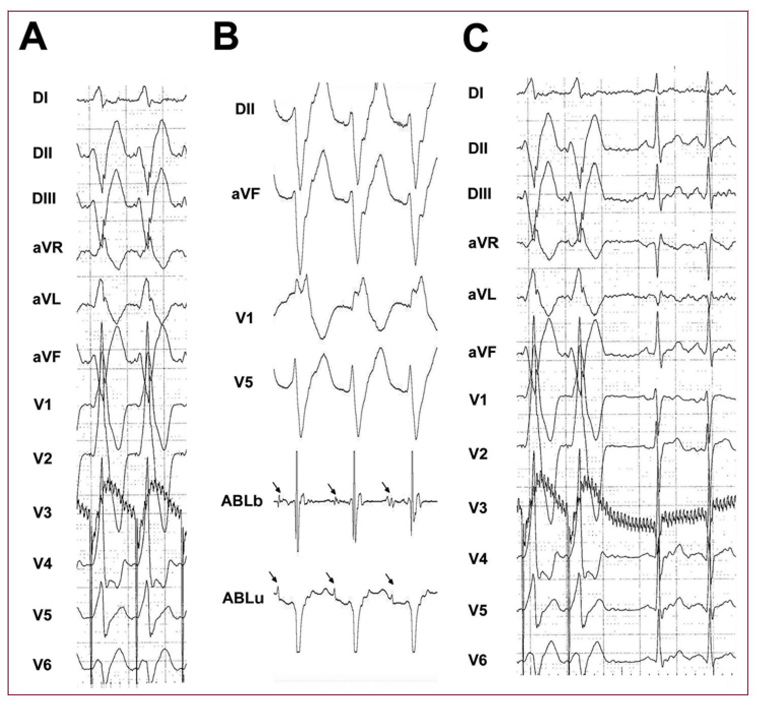 Ablation of Idiopathic Left Ventricular Tachycardia Using Remote ...