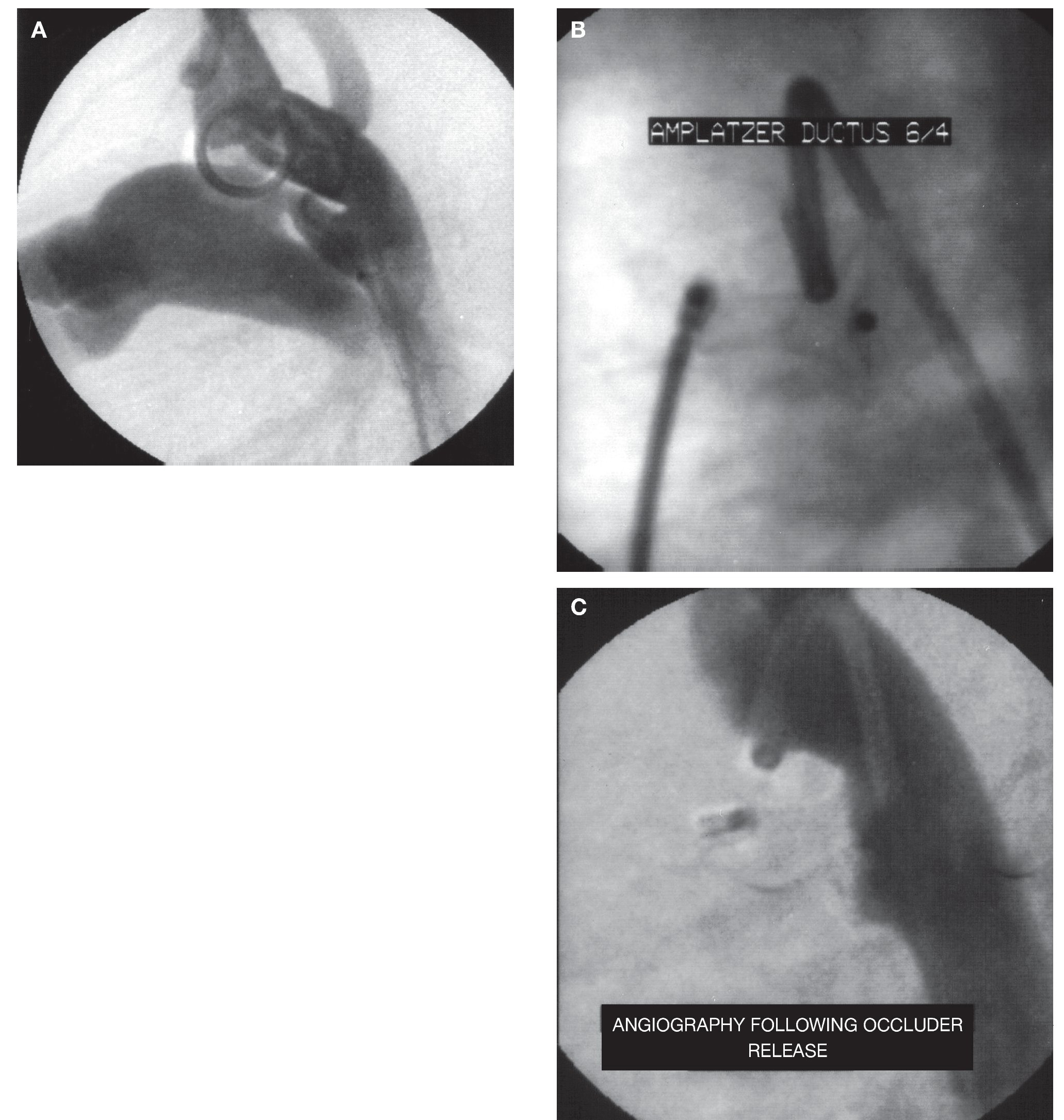 Transcatheter Closure of Patent Ductus Arteriosus Using the Amplatzer ...