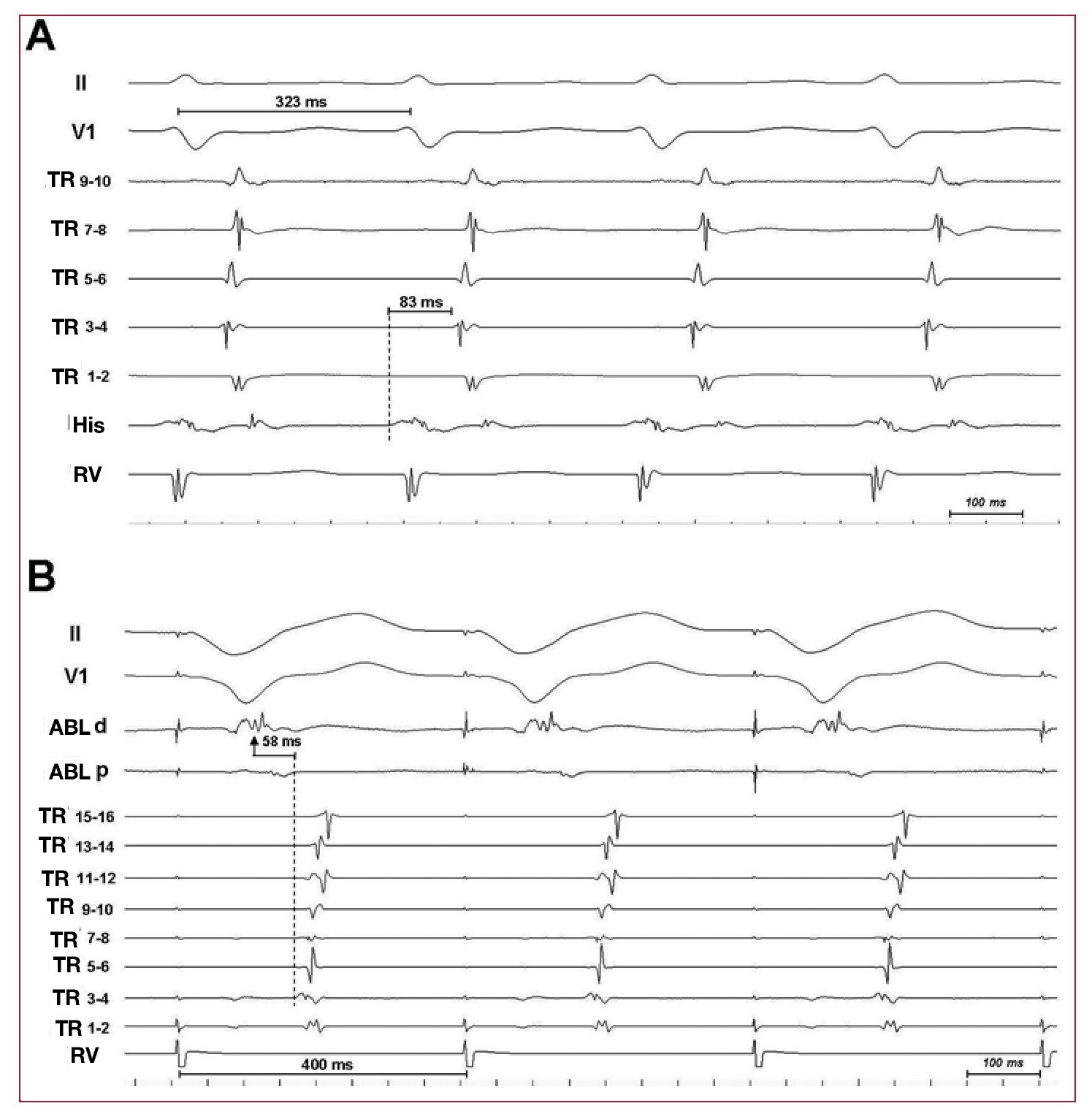 Catheter Ablation of a Concealed Accessory Pathway Between the Right ...