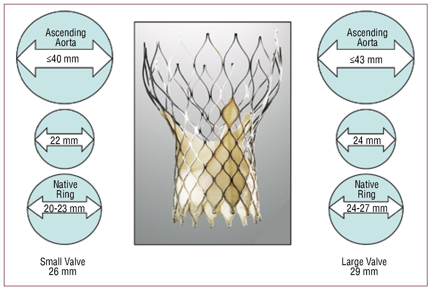 Percutaneous Implantation of the CoreValve® Self-Expanding Aortic Valve ...