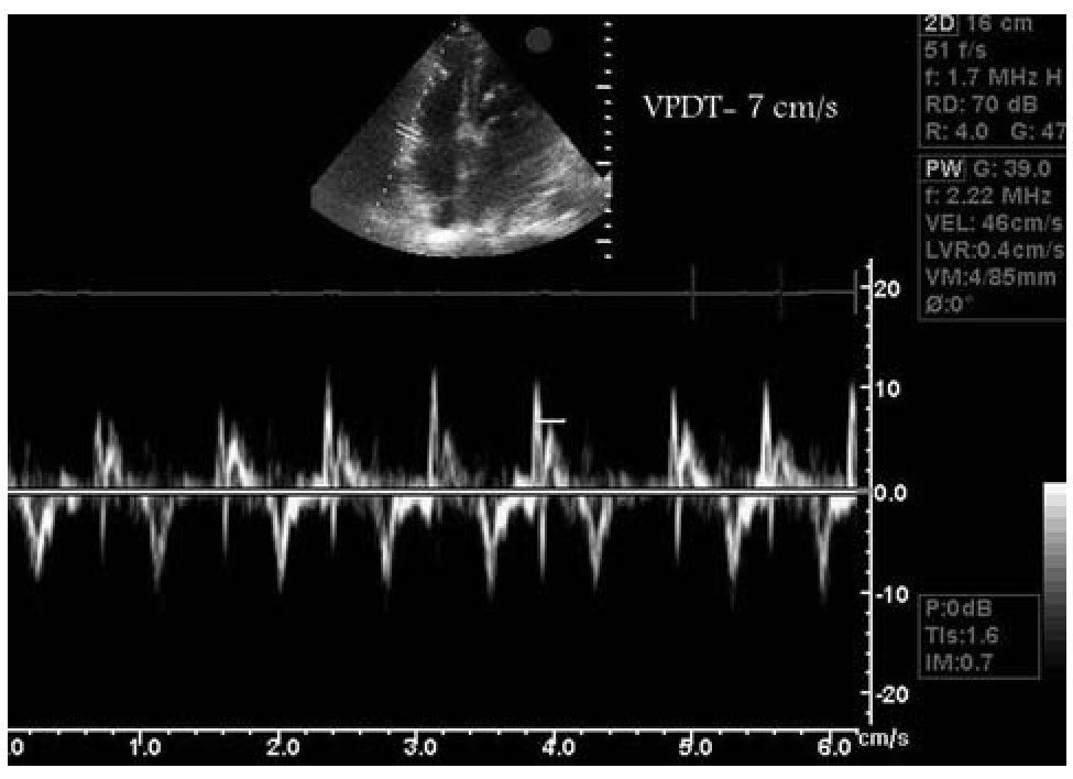 Inter And Intra Observer Variability In The Echocardiographic Evaluation Of Right Ventricular 0344